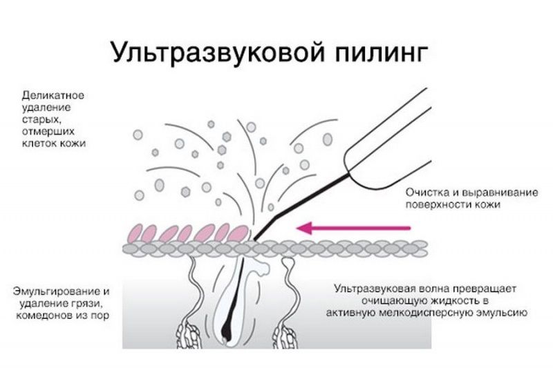 24410 Аппарат ультразвукового пилинга Nova NewFace NV-232A Nova NewFace (НОВА НьюФейс)  - Вид №3