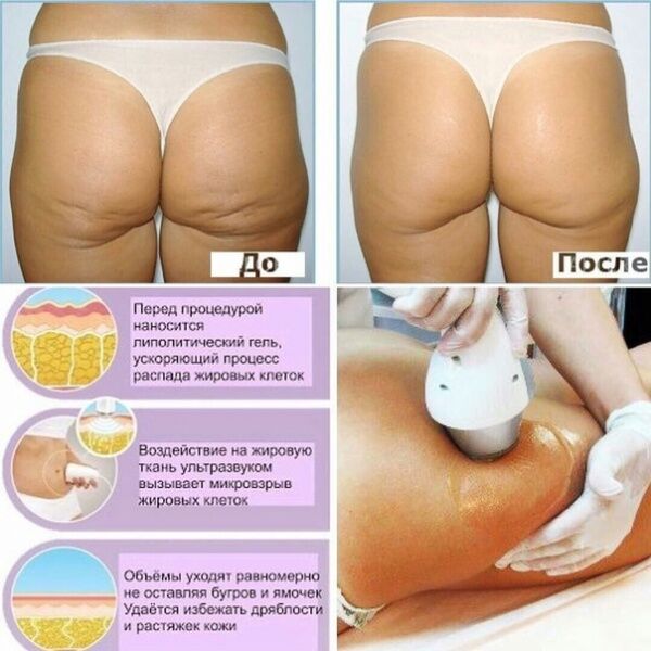 30985 Аппарат 7 в 1 KIM 8 (WL-919s) Липолиз, Кавитация, РФ, Вакуум AURO  - Вид №1