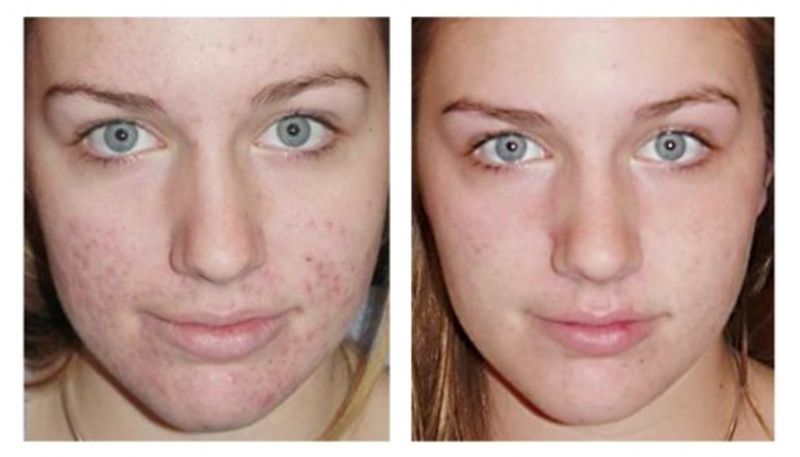 24212 Аппарат алмазной дермабразии Nova NewFace NV-108 (2 в 1) Nova NewFace (НОВА НьюФейс)  - Вид №5